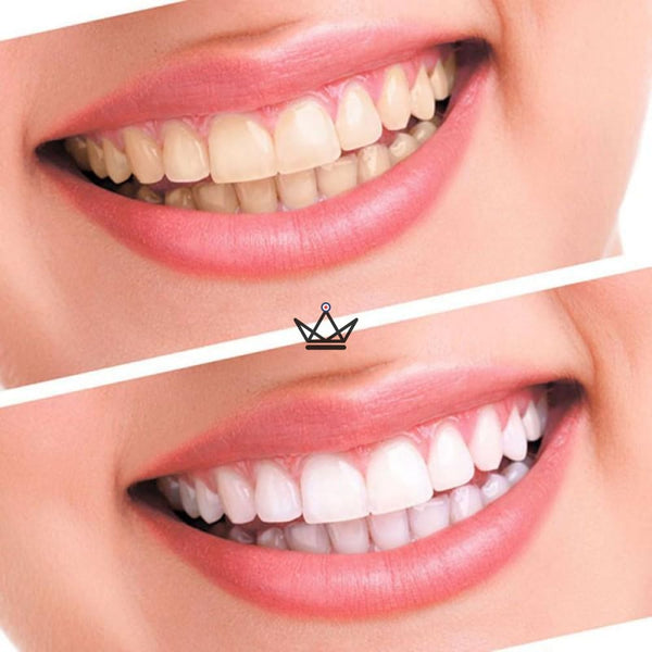 HAPPYDENTS - Kit de blanchiment des dents - Atelier Atypique